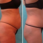 Plastic Surgeon Perth - Tummy Tuck Abdominoplasty plus Liposuction: 4 weeks post-operation