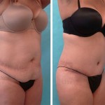 Plastic Surgeon Perth - Tummy Tuck Abdominoplasty plus Liposuction: 6 weeks post-operation