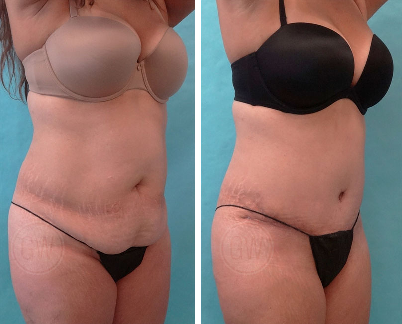 Plastic Surgeon Perth - Tummy Tuck Abdominoplasty plus Liposuction: 6 weeks post-operation