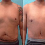 Plastic Surgeon Perth - Tummy Tuck Abdominoplasty plus Liposuction Chest and Abdomen