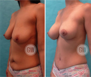 Bilateral breast augmentation mastopexy + abdominoplasty