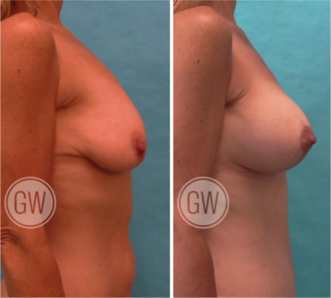 Bilateral breast augmentation mastopexy + abdominoplasty