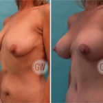 Bilateral breast augmentation mastopexy + abdominoplasty