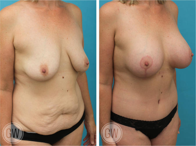 Breast Lift & Implants + Tummy Tuck + Buttock Lift + Arm Lift