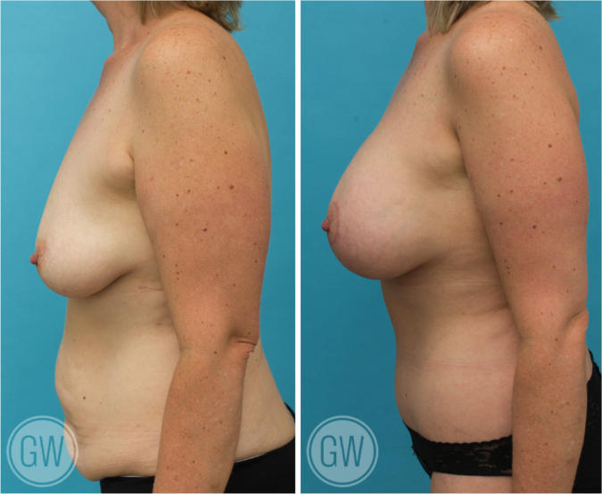 Breast Lift & Implants + Tummy Tuck + Buttock Lift + Arm Lift