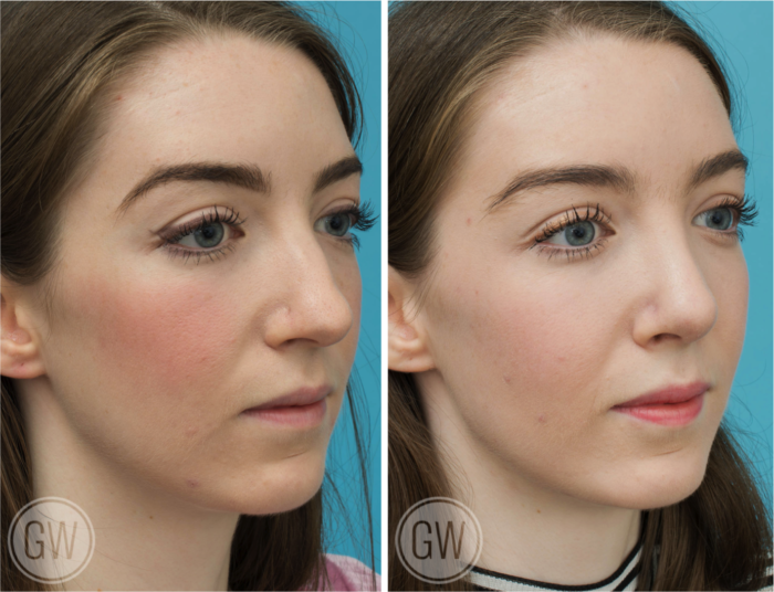 Top 5 ways to Improve Your Nose 5 Popular Nose Job Procedures