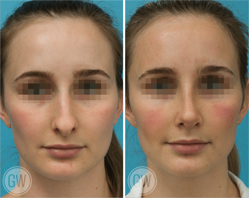 Top 5 ways to Improve Your Nose - 5 Popular Nose Job Procedures Blog Image - Rhinoplastia1-1024x814