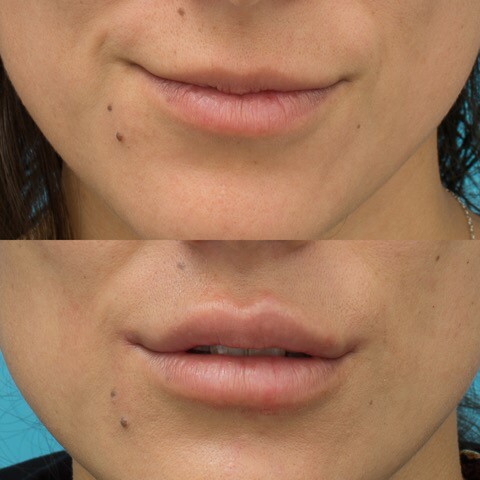 Top lip 0.6ml of filler and 0.4ml of Filler to the bottom - Emma Di Falco