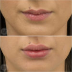 Lip filler 0.8ml- Emma Di Falco