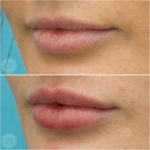 Lip enhancement with vermillion volume and shaping to the white roll and cupids bow - Emma Di Falco