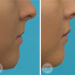 1ml shared between the upper and lower lips