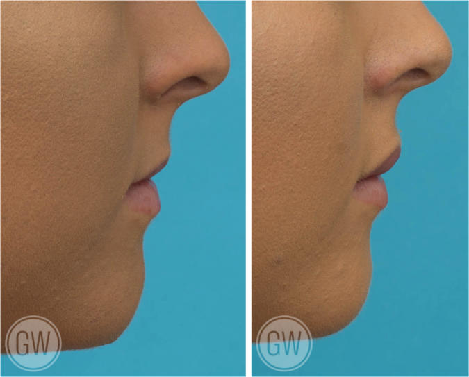 1ml shared between the upper and lower lips