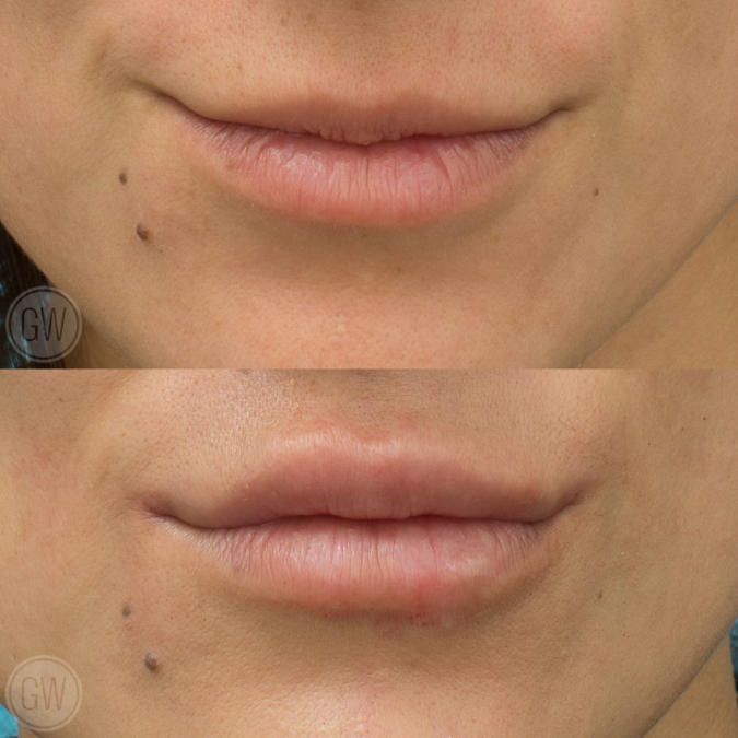 Top lip 0.6ml of filler and 0.4ml of Filler to the bottom - Emma Di Falco