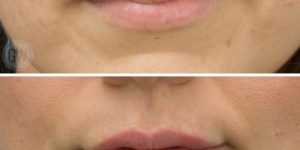 1ml of Lip Filler - Emma Di Falco