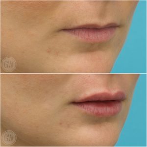 lips eversion 1ml filler