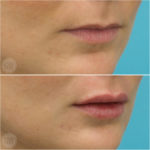 Lip filler to evert and volumise the lips - Emma Di Falco