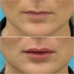 Lip filler to evert and volumise the lips - Emma Di Falco