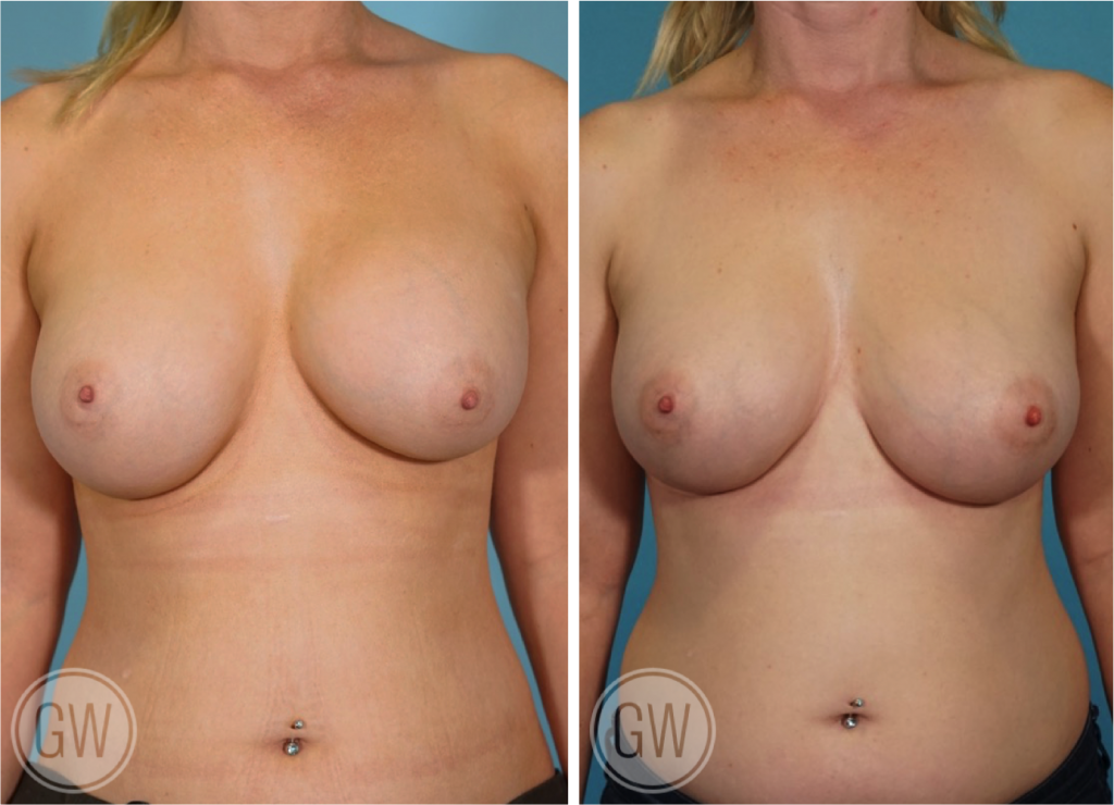 Breast Augmentation Revision
