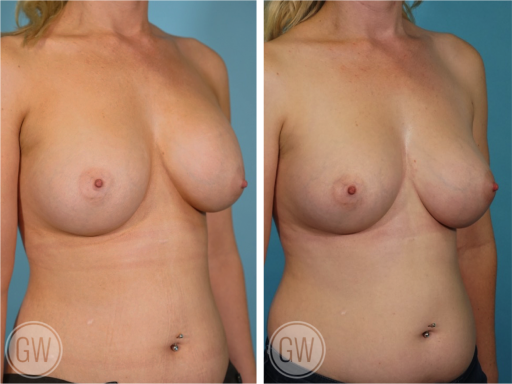 Breast Augmentation Revision