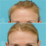 Forehead wrinkle relaxersTear trough fillers - Emma Di Falco