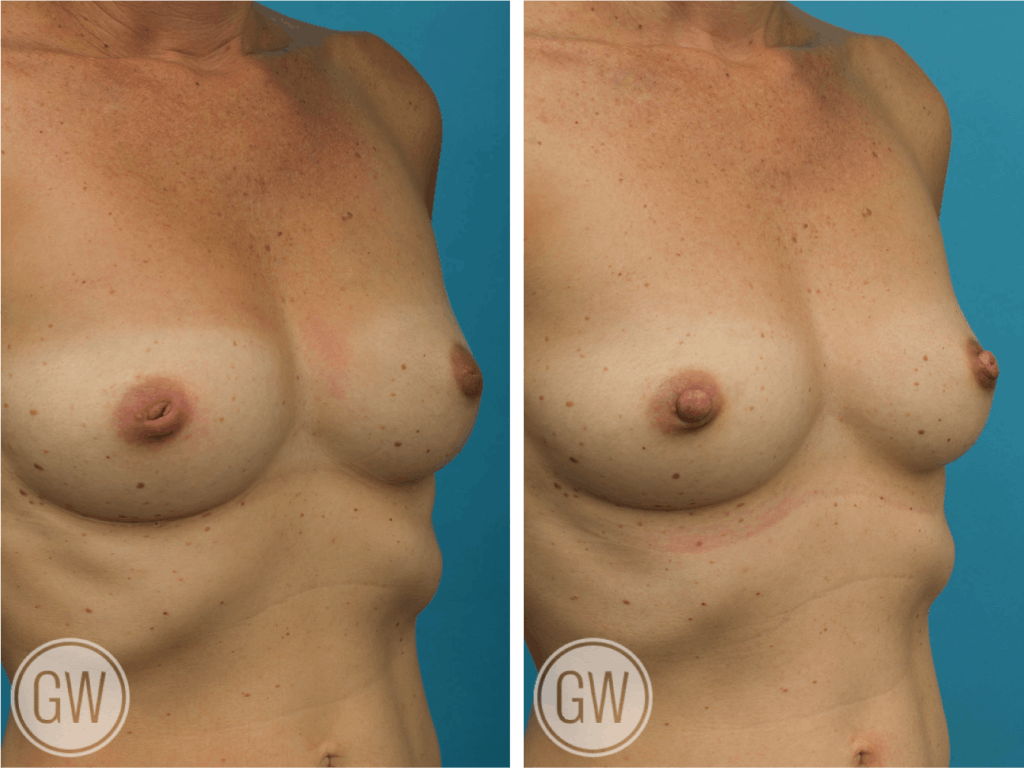 Inverted nipple correction