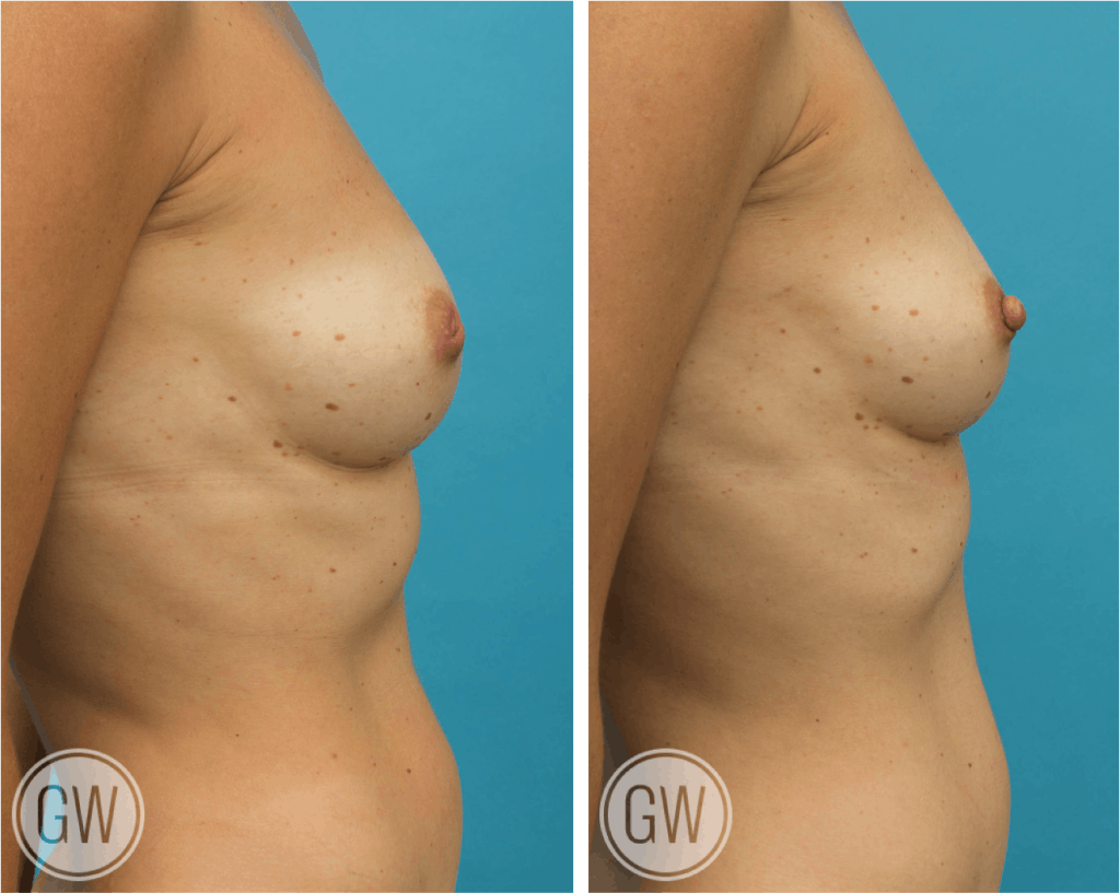 Inverted nipple correction