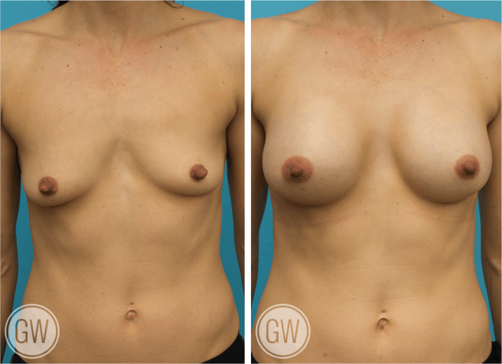 Nipple reduction +300cc dual plane anatomical breast implants