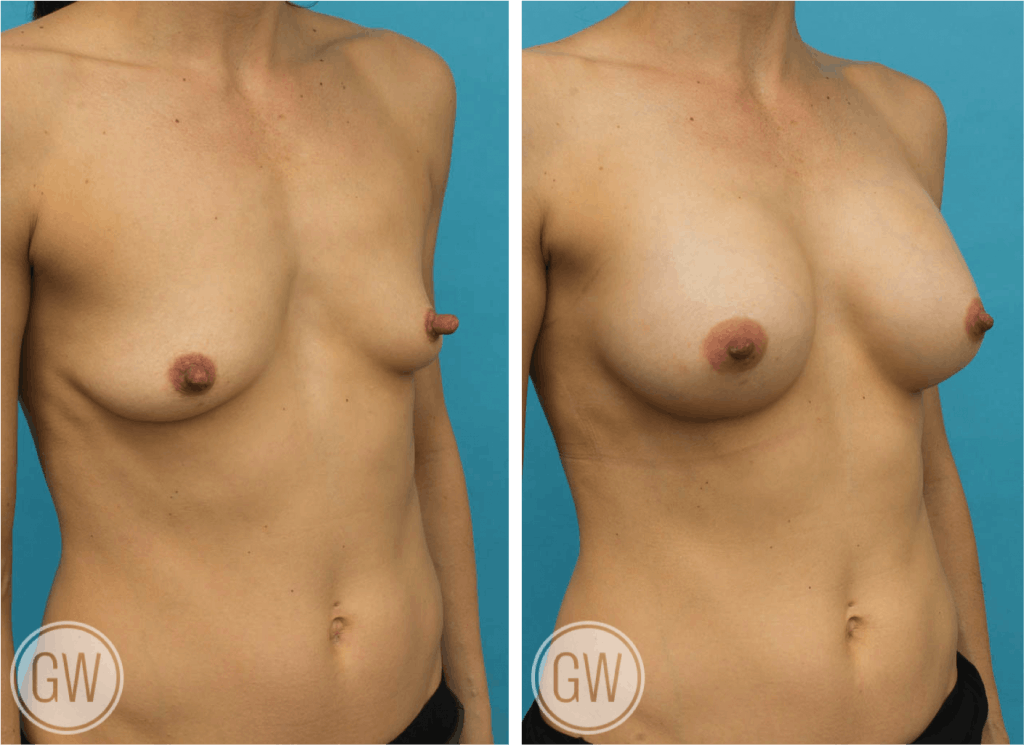 Nipple reduction +300cc dual plane anatomical breast implants