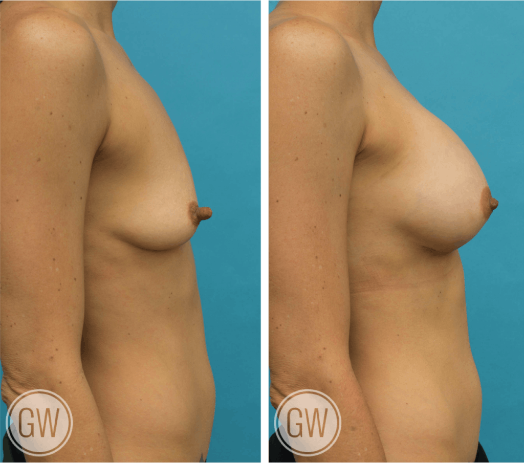 Nipple reduction +300cc dual plane anatomical breast implants