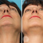 Rhinoplasty + facelift + neck lift + upper and lower eyelid surgery