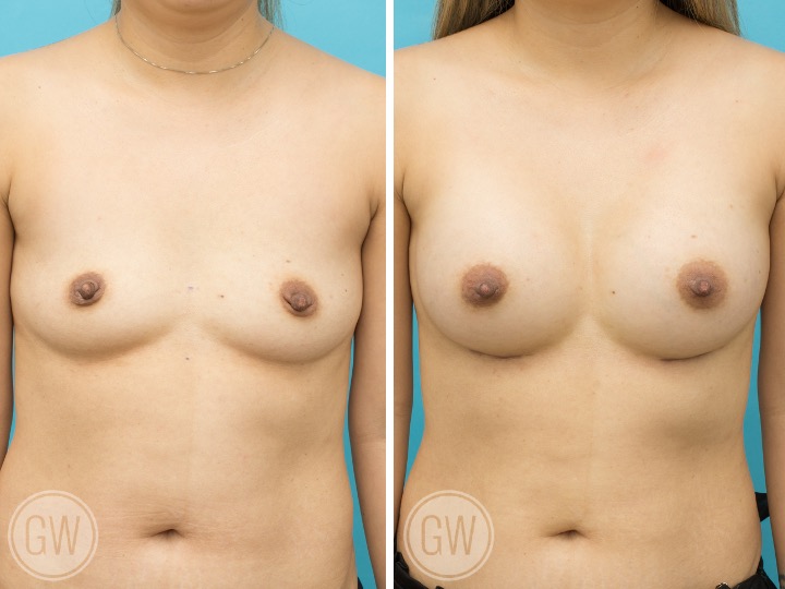 ASIAN BREAST IMPLANTS - Implant: 275cc