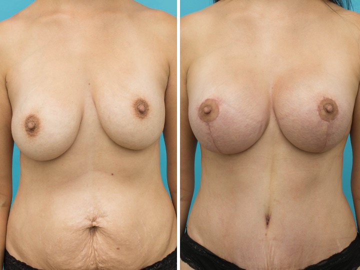 Breast Implants Revision Before and After Photos - Dr Guy Watts Perth WA