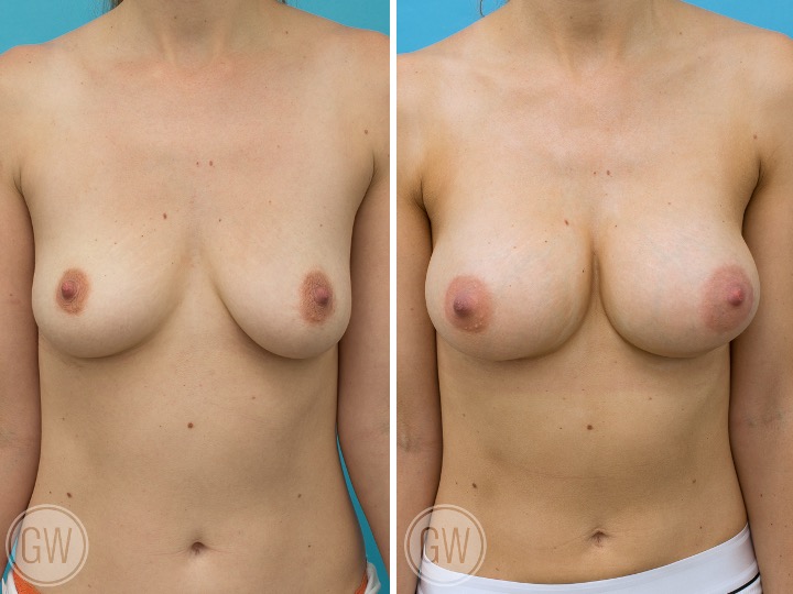 BREAST RESHAPING WITH FAT GRAFTING- Implant: 295cc