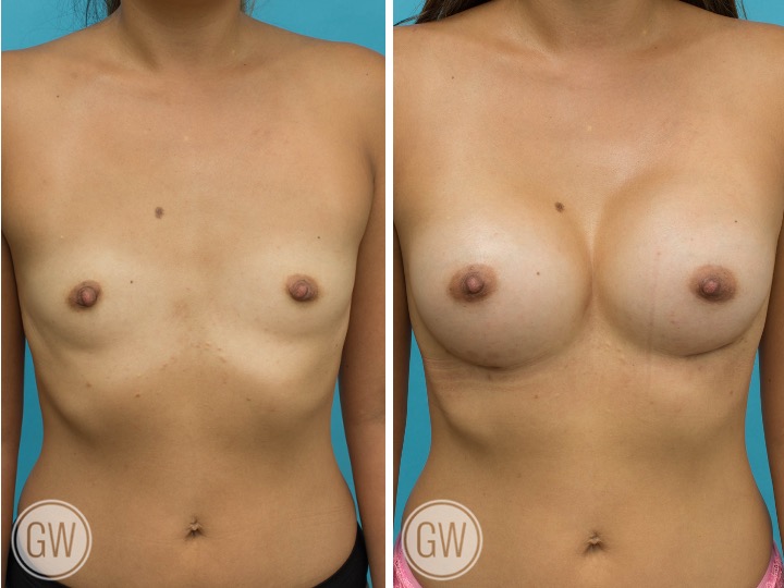ASIAN BREAST IMPLANTS - Implant: 350 cc