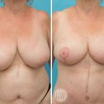 Reduction: Right 450cc Gland Removal – Left 350cc Gland Removal