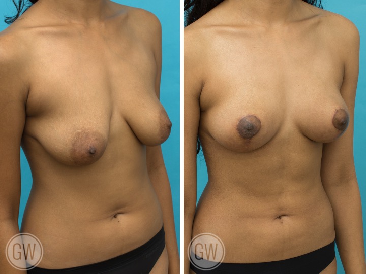 Breast Lift Breast Lift: Fat Grafting 60cc Per Side