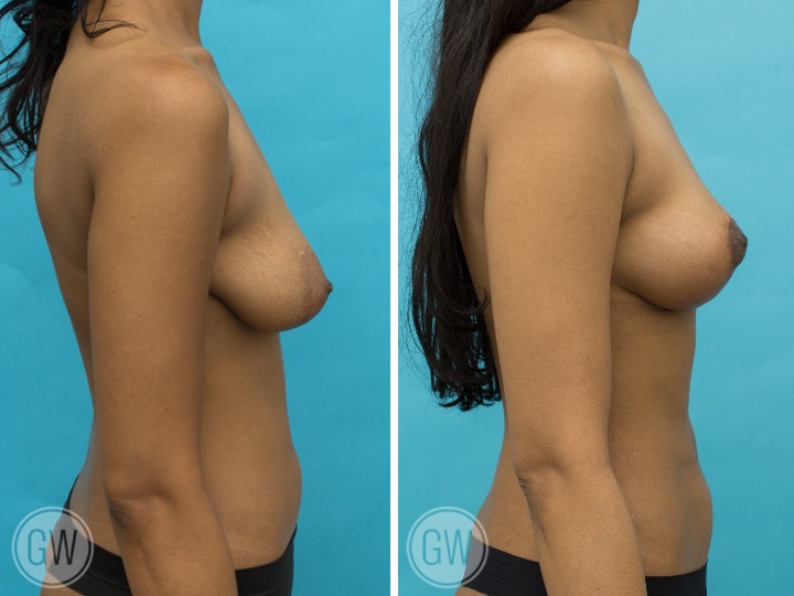 Breast Lift Breast Lift: Fat Grafting 60cc Per Side