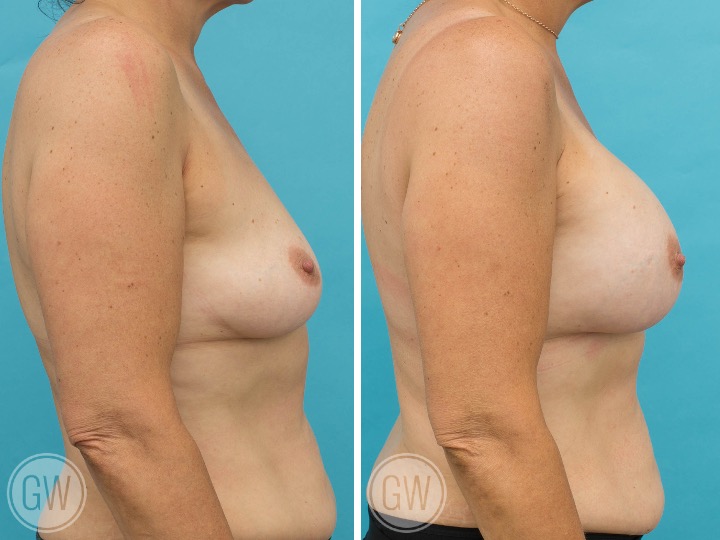 400cc Implant: 400cc Smooth Round, Moderate Plus Profile