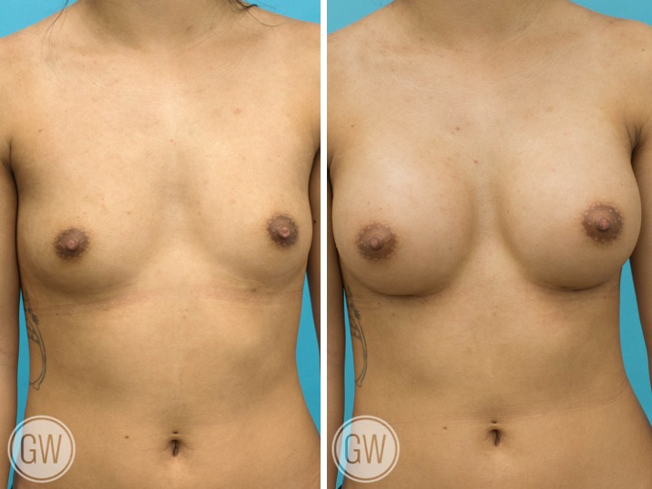 ASIAN BREAST IMPLANTS - Implant: 295 cc