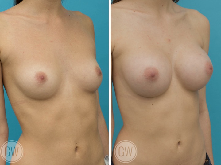275cc Implant: 275cc Smooth Round, Moderate Plus Profile