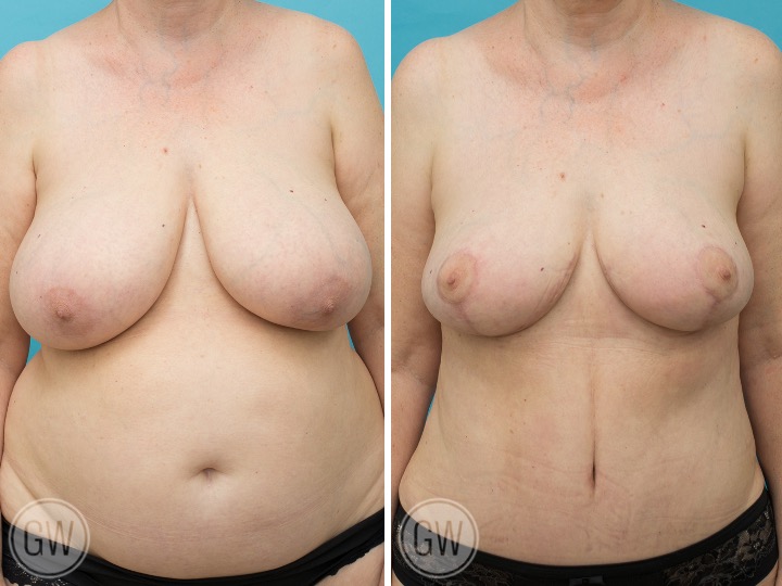 Breast Reduction and Lift Gallery Before and After Photos - Dr Guy Watts Plastic Surgeon