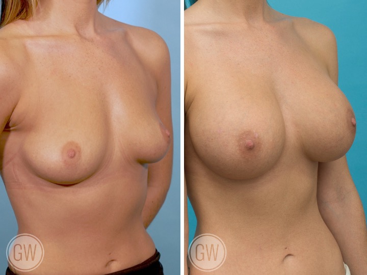 450cc/425cc Implant: Left- 450cc Smooth Round, High Profile, Right - 425cc Smooth Round, High Profile