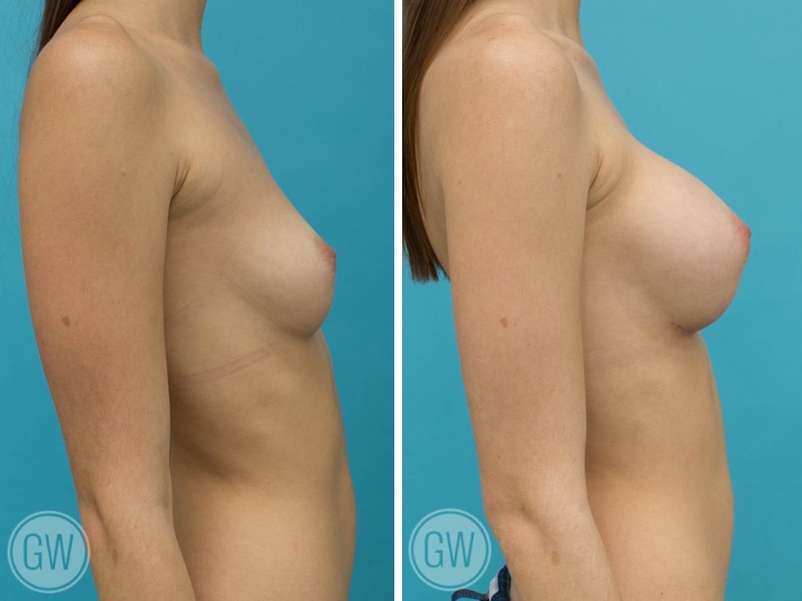 275cc Implant: 275cc Smooth Round, Moderate Plus Profile
