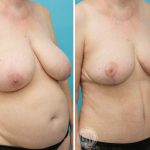 Breast Reduction: 475cc Gland Removal per side