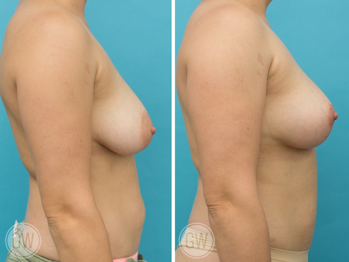 Breast Lift