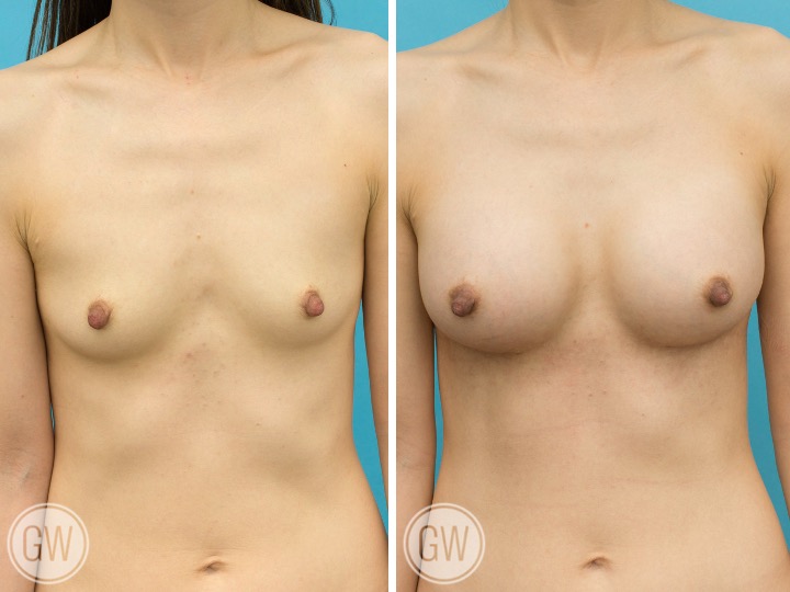 ASIAN BREAST IMPLANTS - Implant: 275 cc