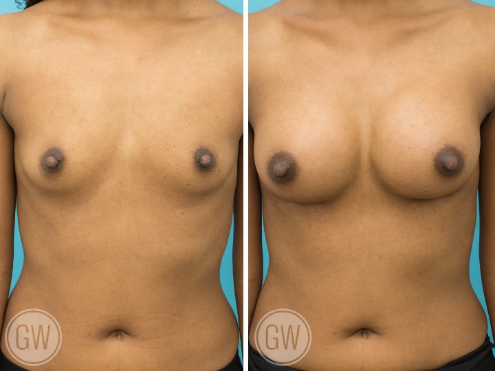 Anatomical Implants Gallery Before and After Image Dr Guy Watts