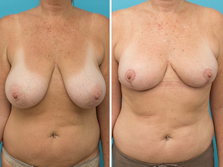 Breast Reduction: 300cc Gland Removal per side
