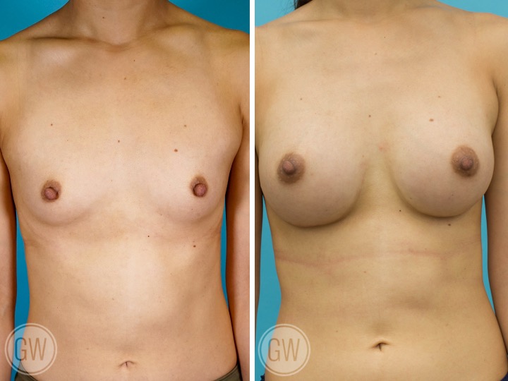 ASIAN BREAST IMPLANTS - Implant 300 cc