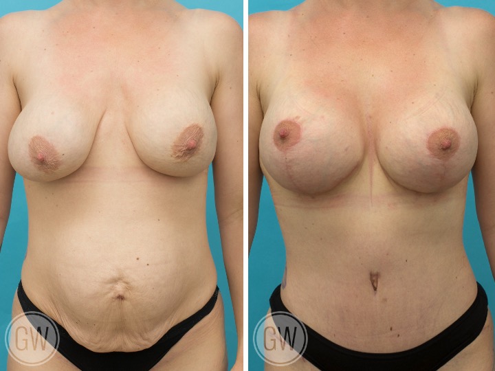 BREAST LIFT AND IMPLANTS -Implant: 535cc